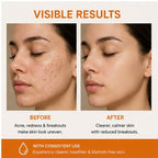 Elyndra Anti Acne Face Serum (30ml) - Oil Control & Clear Looking Skin