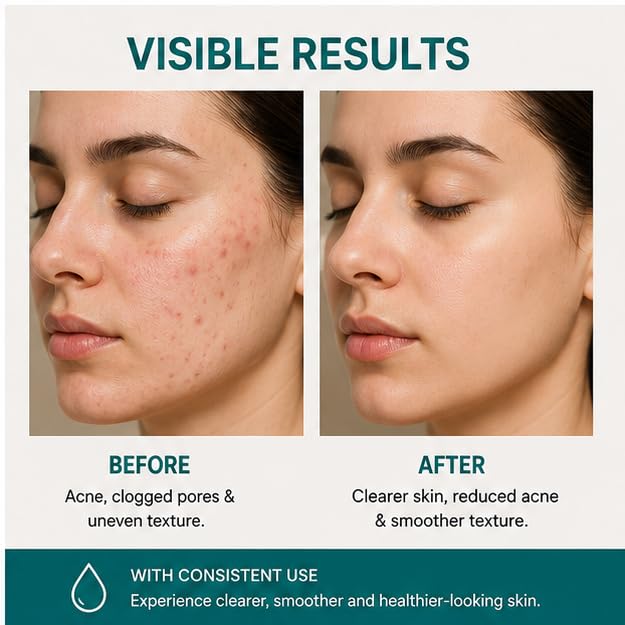Elyndra 1% Salicylic Acid Face Serum (30ml) - Pore Refining & Oil Control