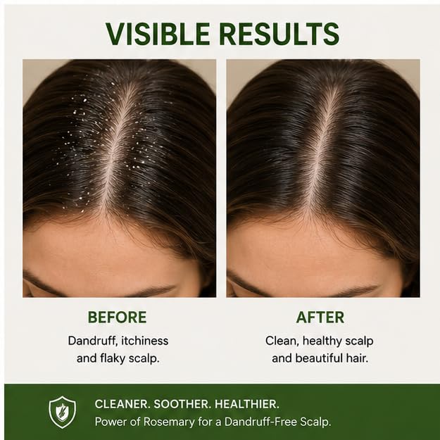 Elyndra Anti Dandruff Shampoo (200ml) - Scalp Cleansing Hair Shampoo & Daily Care Shampoo